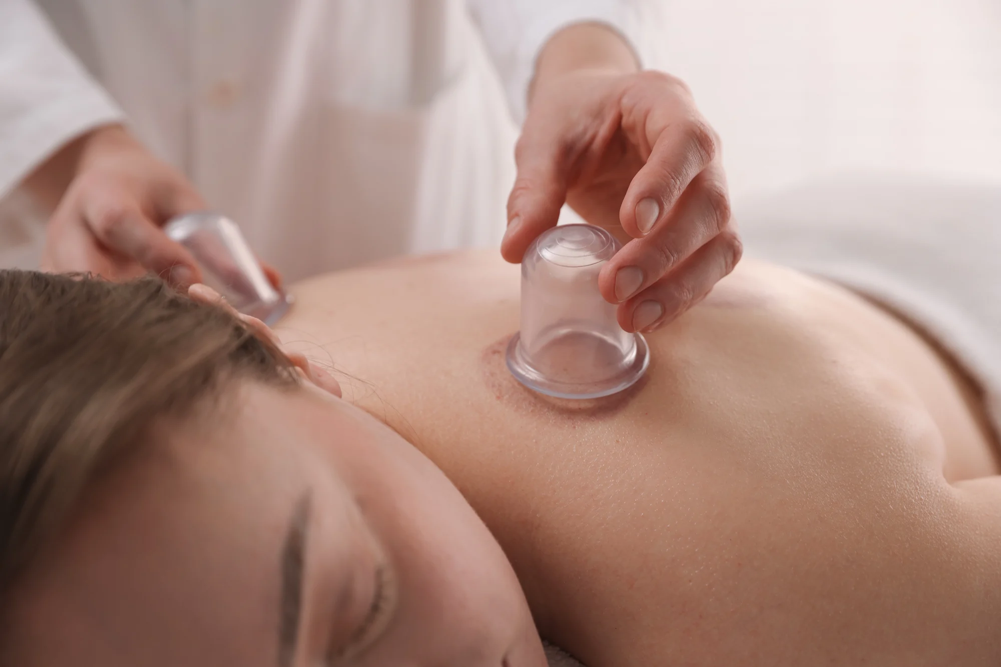 Cupping treatment in Manhattan