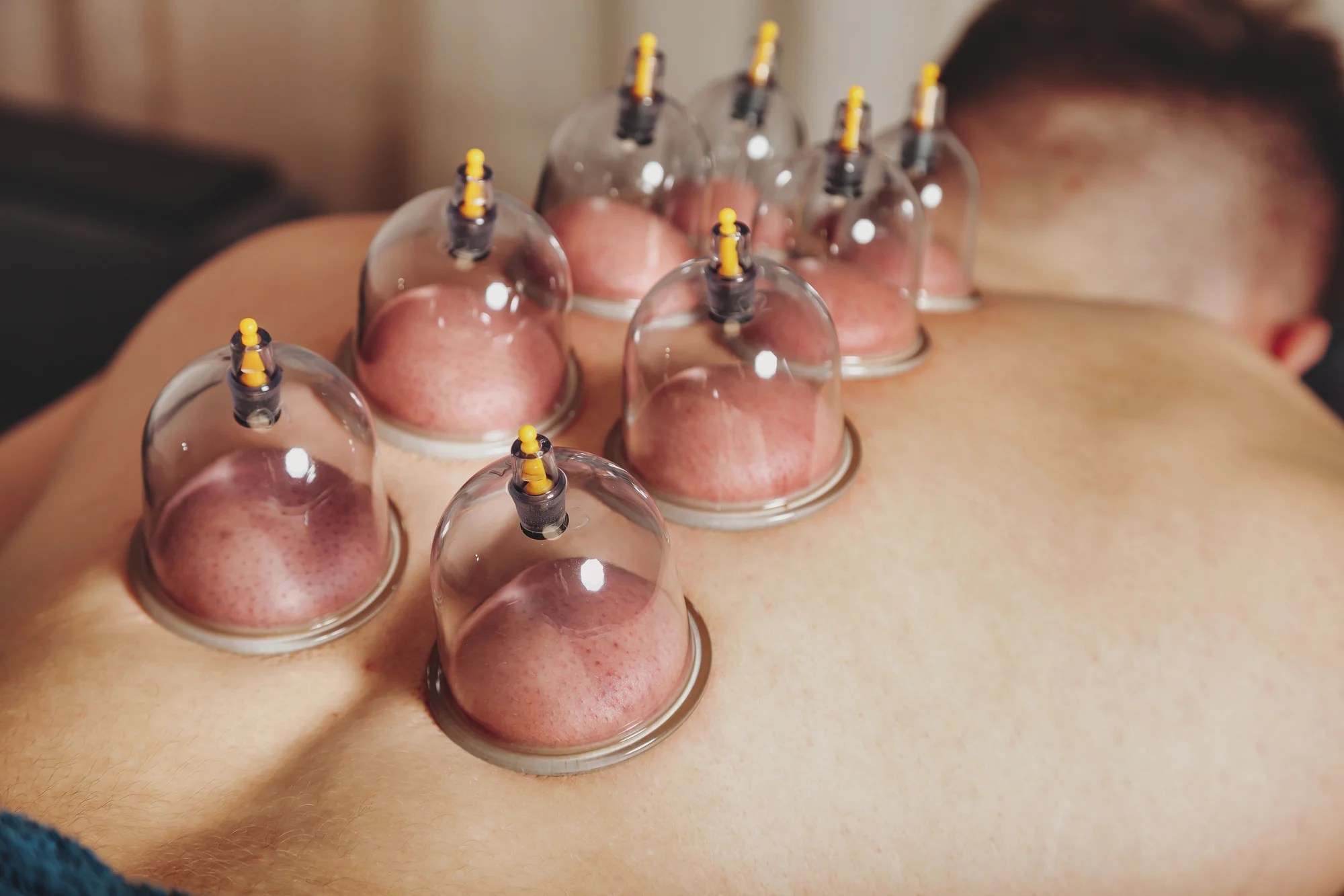 Cupping hands-on care at Moving Forward Physical Therapy