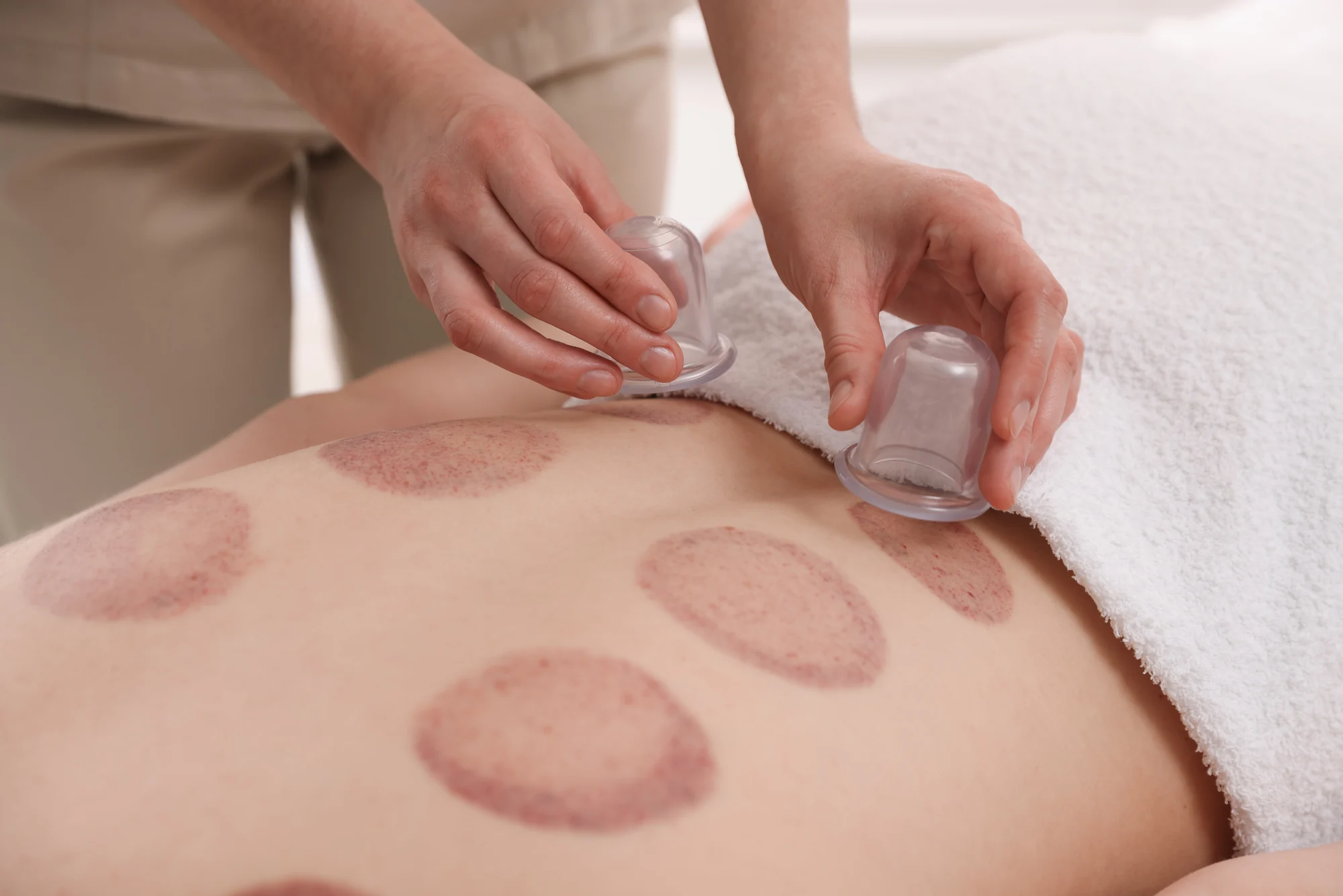 Cupping recovery support in New York City